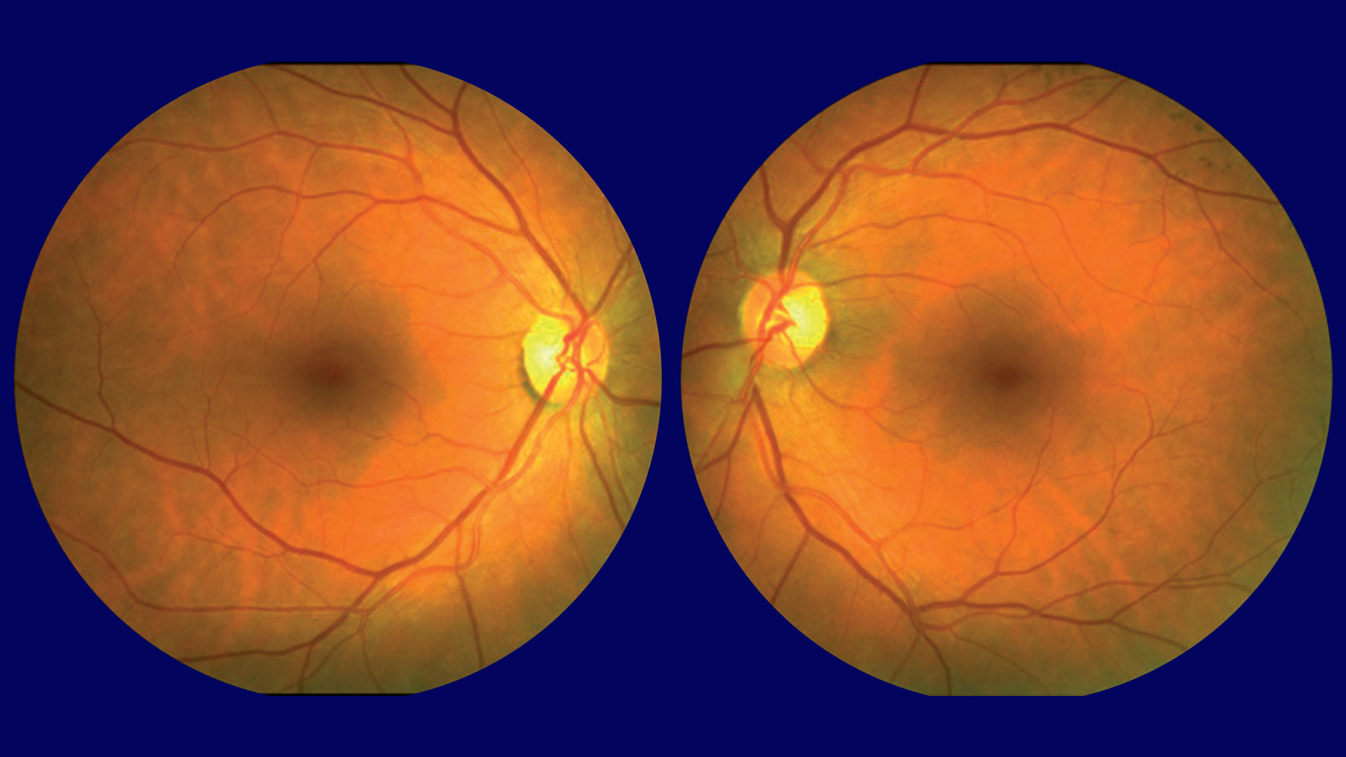 foto fundus